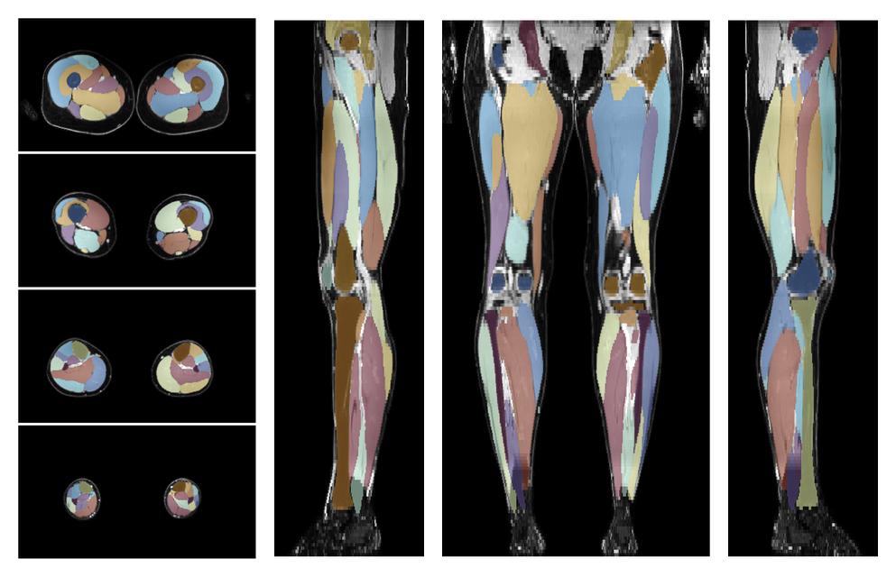 Overlay of automated muscle segmentation labels on dixon water image.